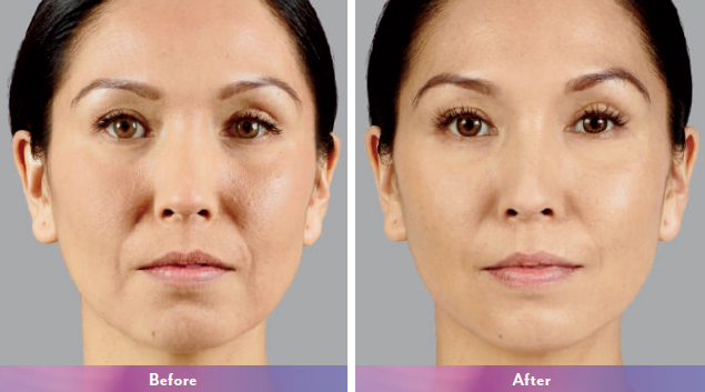 Juvederm-BA-img