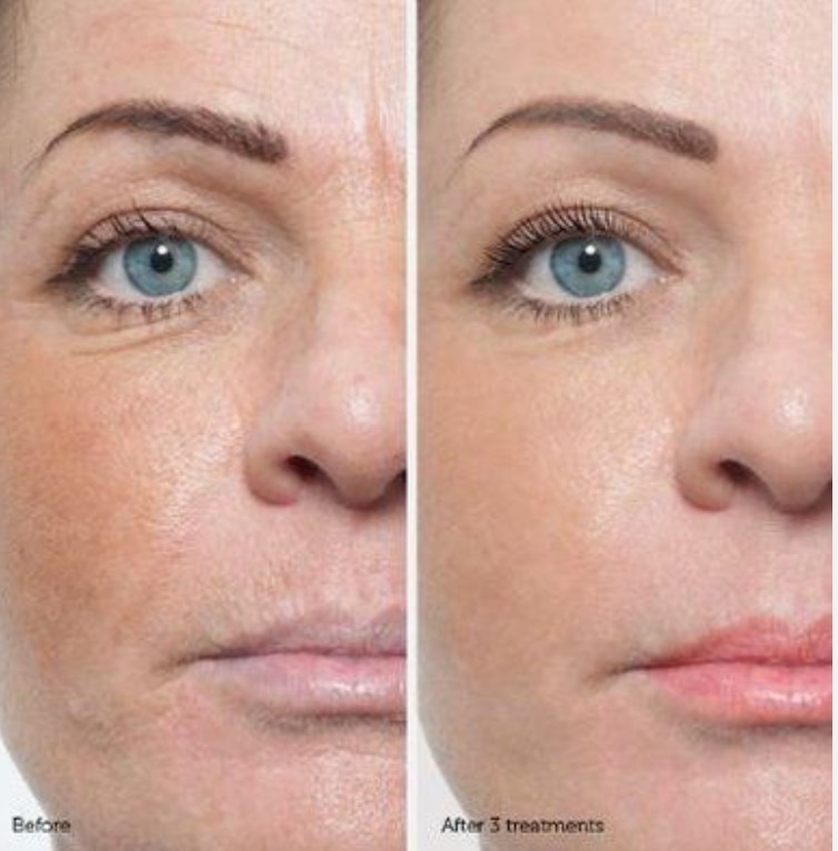 Microderm before after