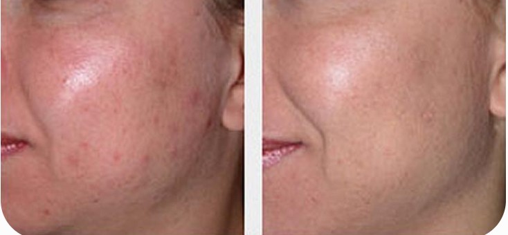 Microderm before after