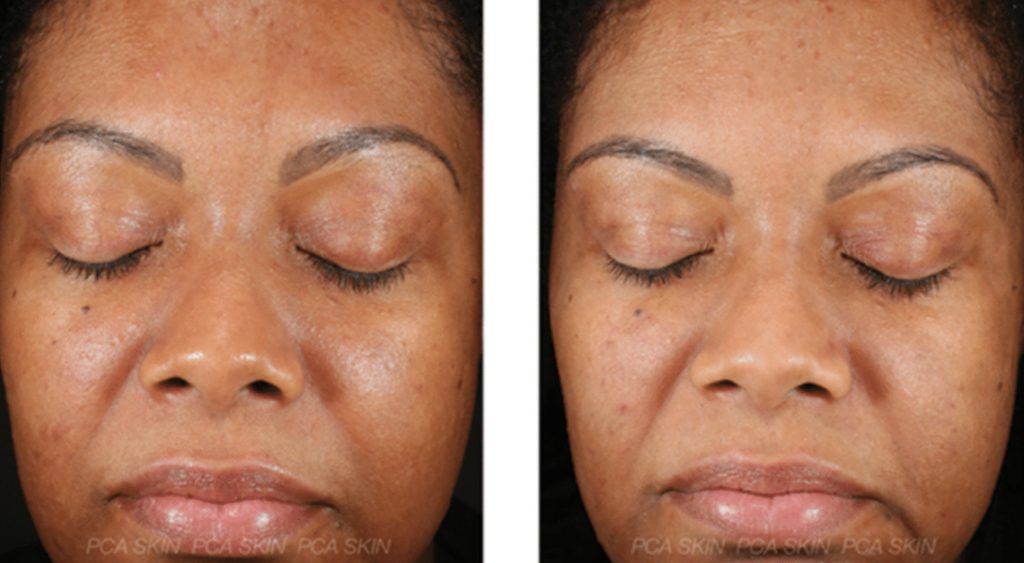 #50 Chemical peel